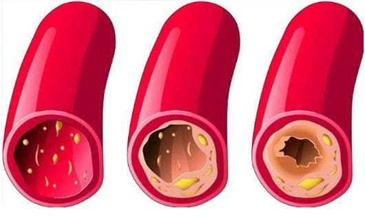 Cardiotensive